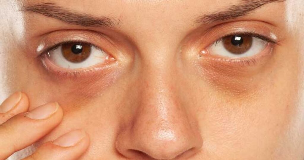 Common Causes of Eye Bags